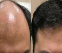 Zioła, które zapobiegają wypadaniu włosów